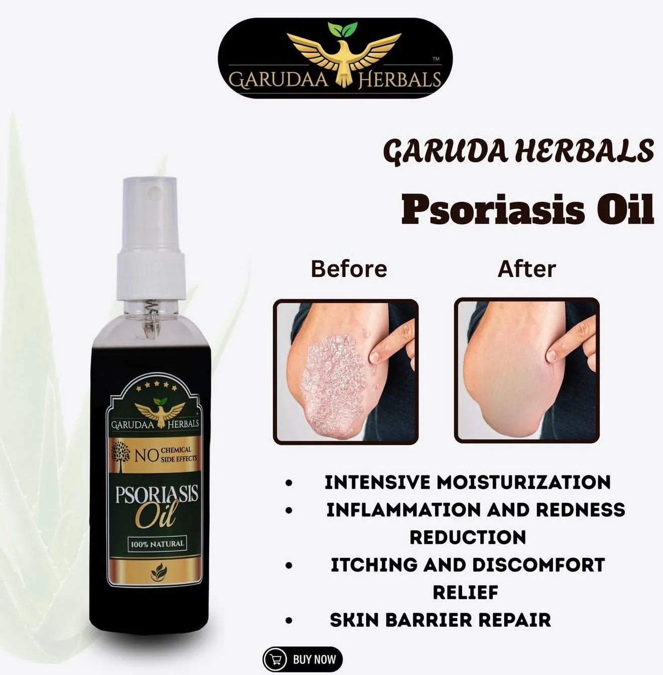 Garuda Herbal Psoriasis -Clearing Oil