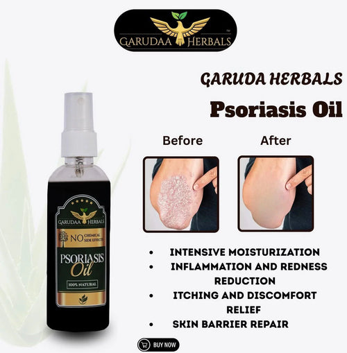 Garuda Herbal Psoriasis -Clearing Oil